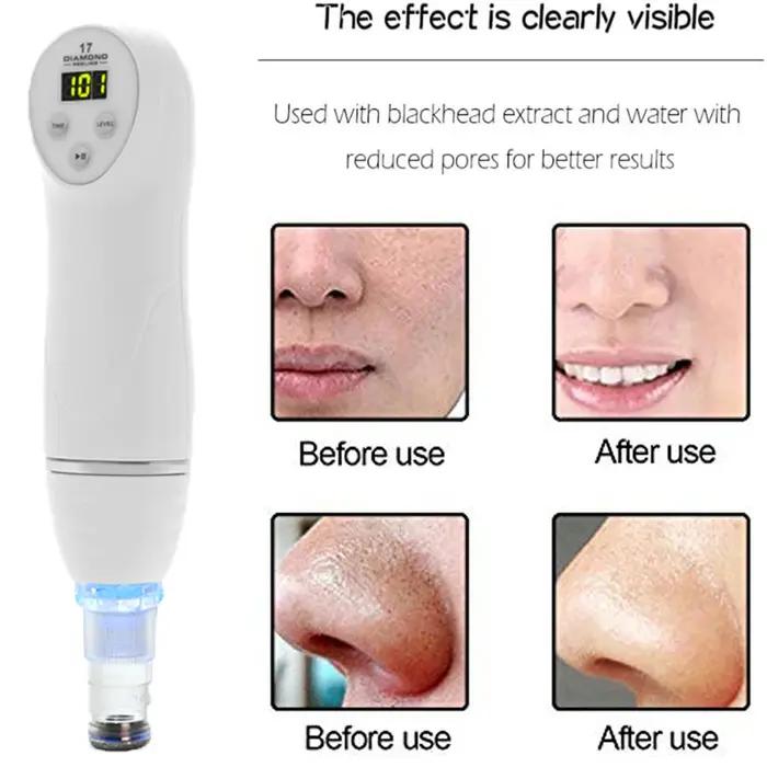 DermDelhi-Machine de peeling de la peau sous vide pour le visage, points noirs, élimination de l'acn