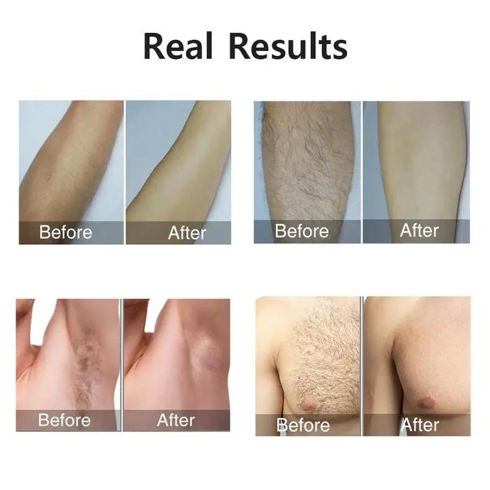 Depilador a laser ipl, remoção de pelos para mulheres, biquíni corporal, facial, 990000 flashes, per