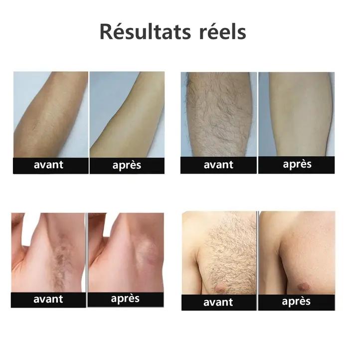 Épilateur laser IPL Peicon pour femmes, épilation permanente et indolore pour le visage, bikini, aisselle et tout le corps occasions spéciales